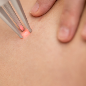 Láser vascular Facial